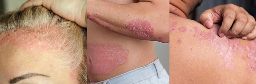 Scall psoriasis, whole body psoriasis