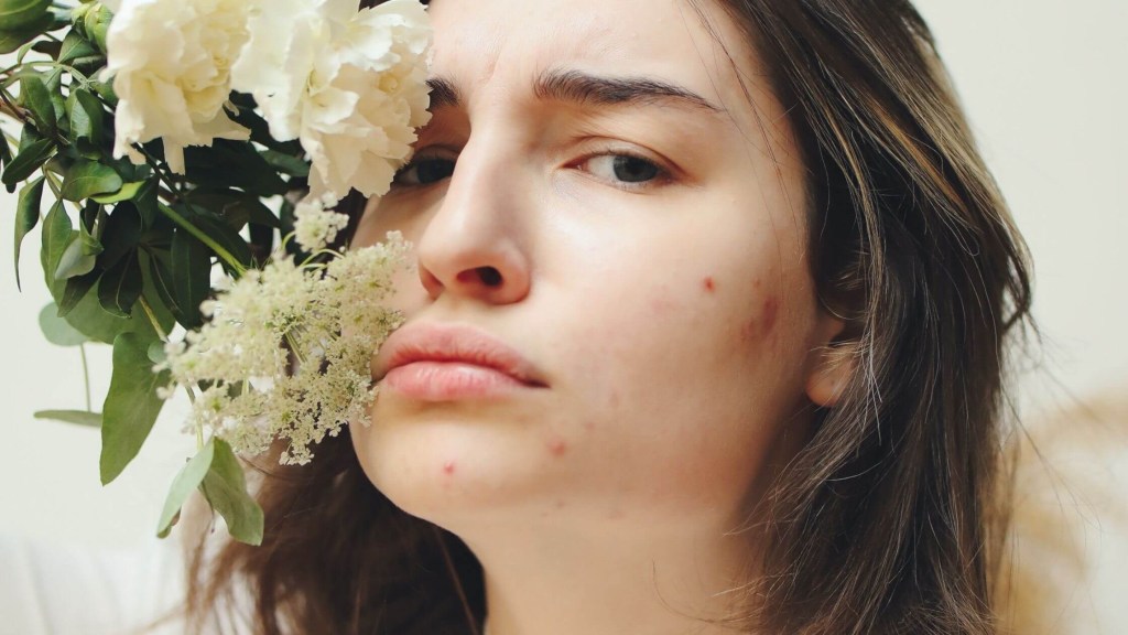Girl with hormonal acne on chin area 