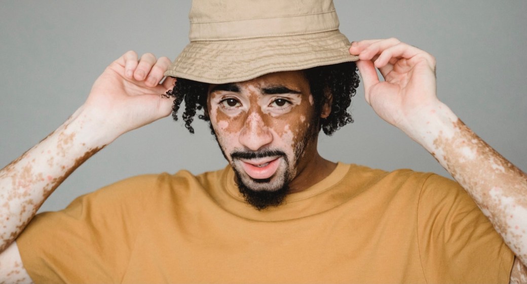 African-men-with-vitiligo-face-healthmonastery