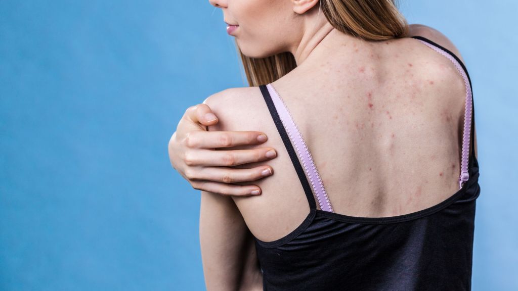 bacne causes and treatment